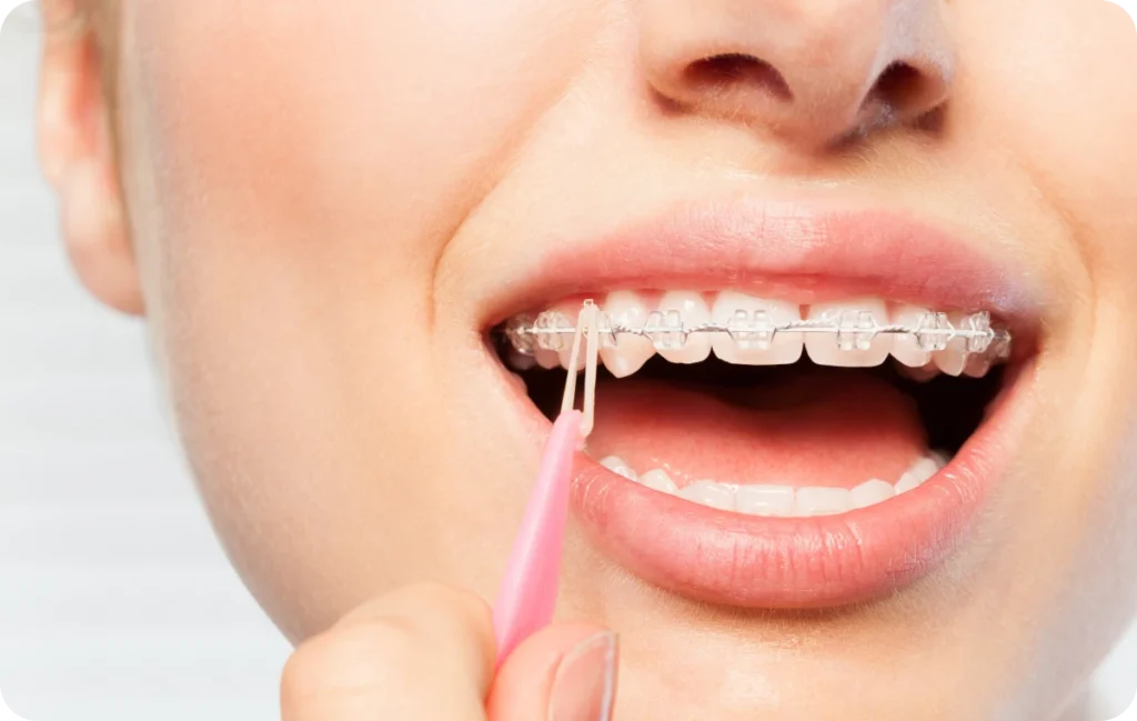 aligneurs invisibles saint prix dr papelard aligneurs invisibles saint prix dr papelard Appareils dentaires céramiques Ermont Eaubonne Orthodontie