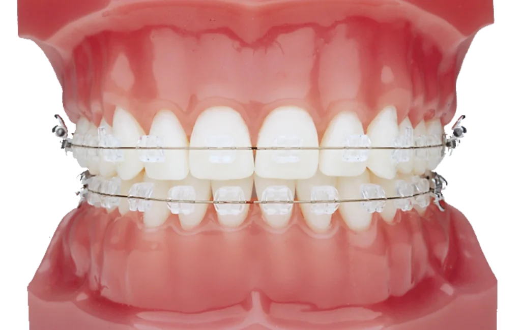 appareil dentaire saint prix dr foucart appareil dentaire saint prix dr foucart Appareil dentaire (céramique) Ermont Eaubonne Orthodontie