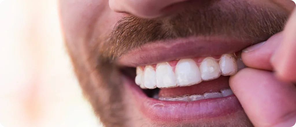 correction dentaire sannois dr foucart correction dentaire sannois dr foucart Aligneurs transparents Ermont Eaubonne Orthodontie