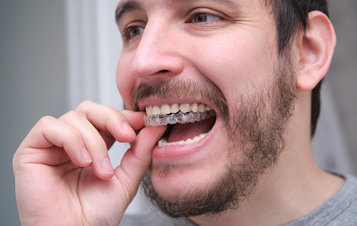 orthodontie bouffemont dr bourriau specialiste Dents qui se chevauchent : quelles solutions ? Ermont Eaubonne Orthodontie