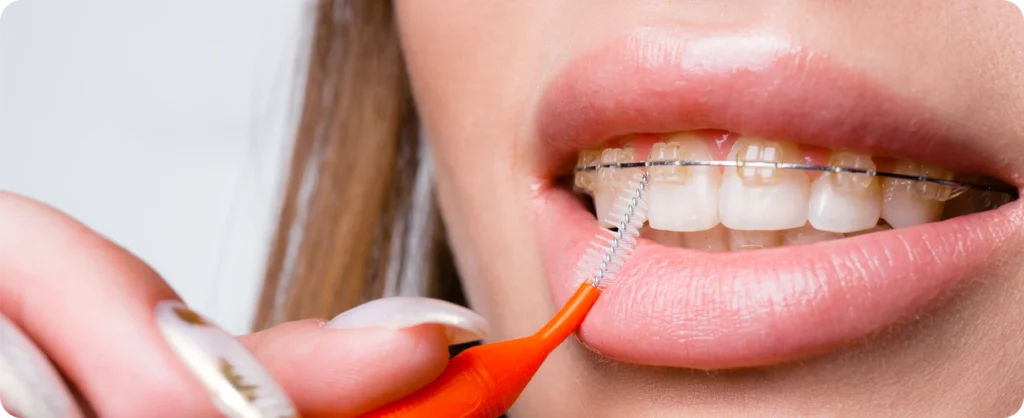 appareil dentaire domont dr foucart appareil dentaire domont dr foucart Orthodontiste Domont Ermont Eaubonne Orthodontie