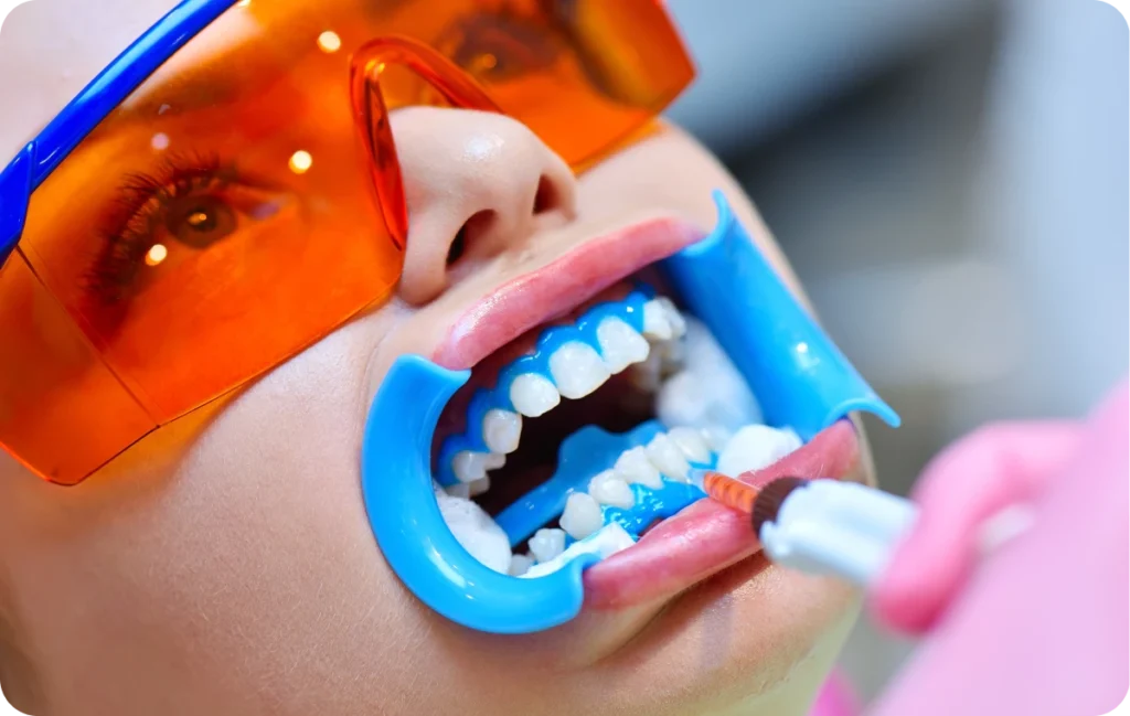 appareil dentaire ermont eaubonne appareil dentaire ermont eaubonne Éclaircissement dentaire Ermont Eaubonne Orthodontie