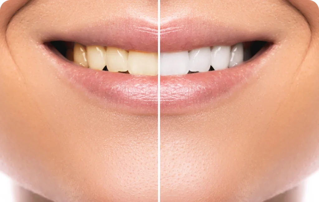 appareil dentaire sannois dr bourriau appareil dentaire sannois dr bourriau Éclaircissement dentaire Ermont Eaubonne Orthodontie