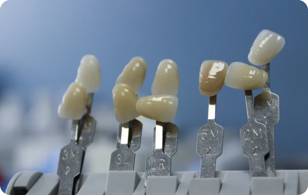 facettes facettes Éclaircissement dentaire Ermont Eaubonne Orthodontie